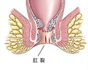 合肥治療肛裂 合肥肛腸?？漆t院 合肥肛門醫院哪家好