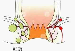 肛瘺危害 肛瘺危害有哪些